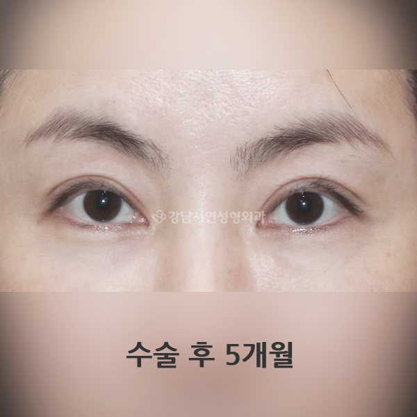 쌍꺼풀 재수술 라인 낮추기 AFTER