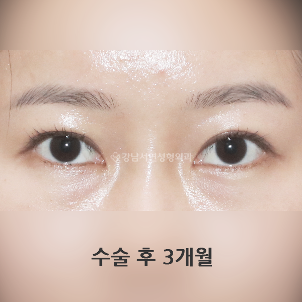 라인 낮추기 AFTER