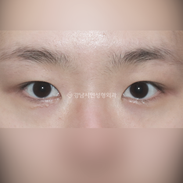 매몰쌍꺼풀+앞트임 BEFORE