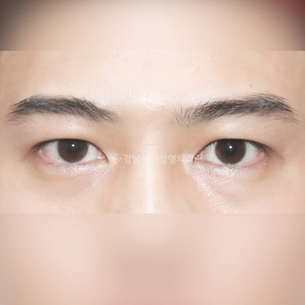 비대칭교정 재수술 AFTER