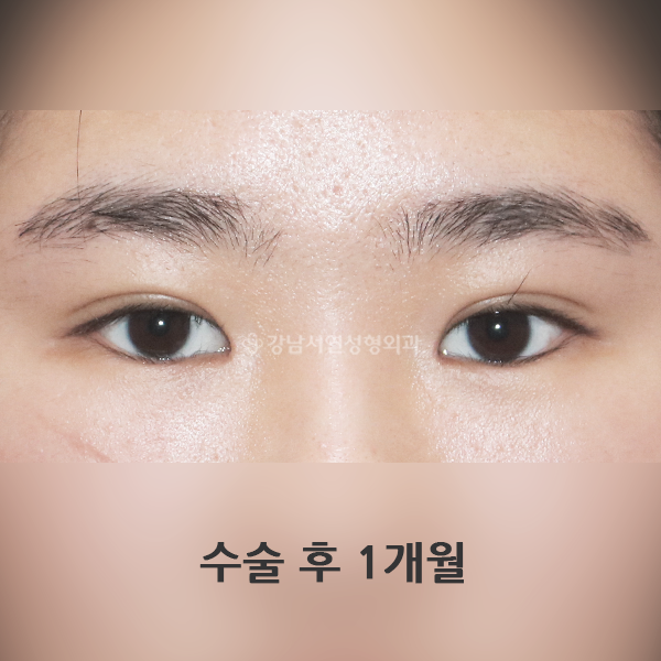 절개쌍꺼풀+앞트임 AFTER