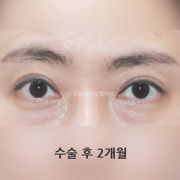 절개 쌍꺼풀 재수술 AFTER