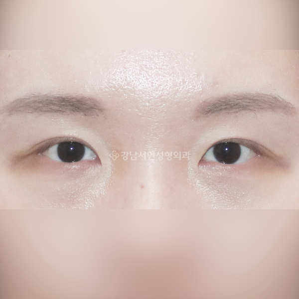 라인 낮추기 AFTER