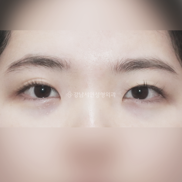 매몰쌍꺼풀+앞트임 BEFORE