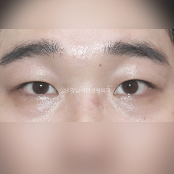남자 무쌍눈매교정 AFTER