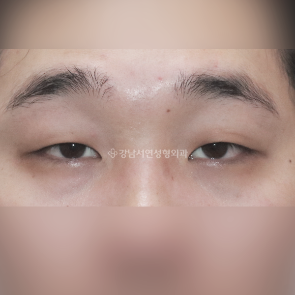 남자 무쌍눈매교정 BEFORE