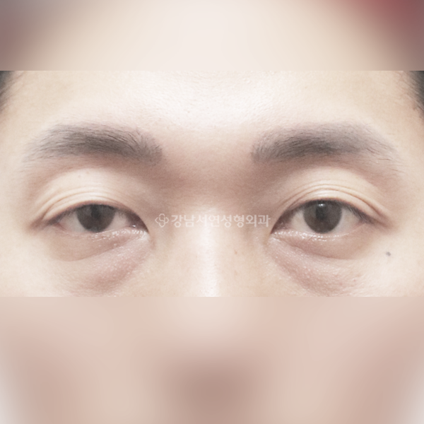 남자 무쌍눈매교정 BEFORE