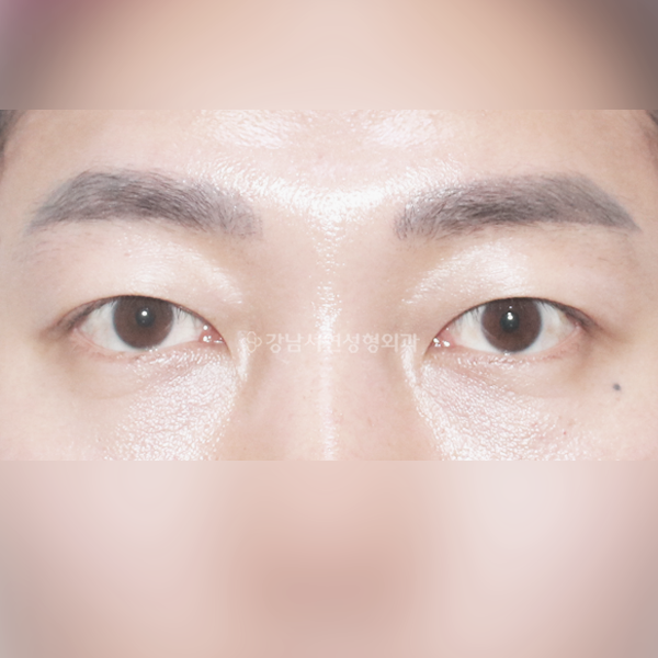 남자 무쌍눈매교정 AFTER