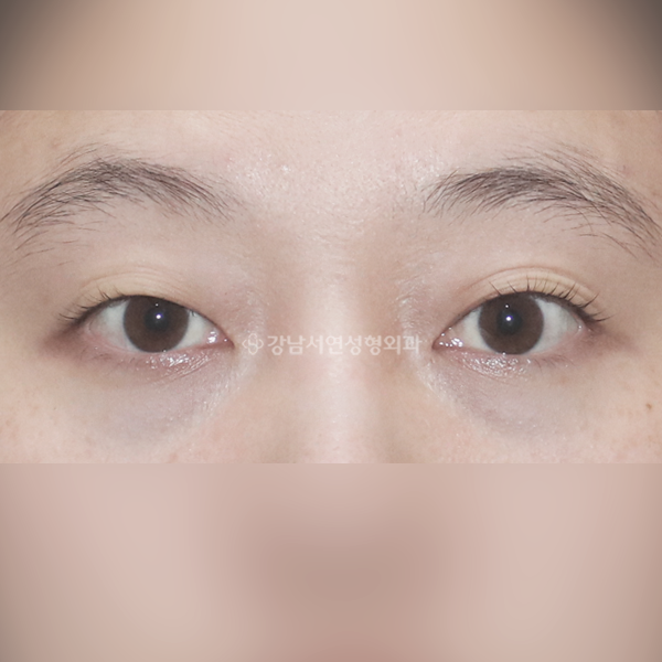 절개쌍꺼풀 BEFORE