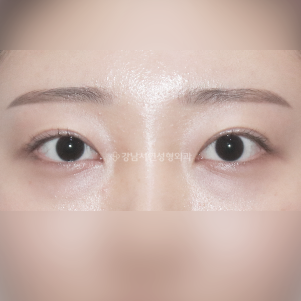 라인 낮추기 AFTER