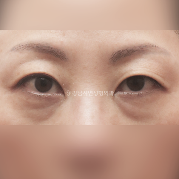 상안검 하안검 BEFORE