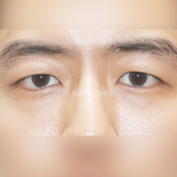 눈밑지방재배치 AFTER