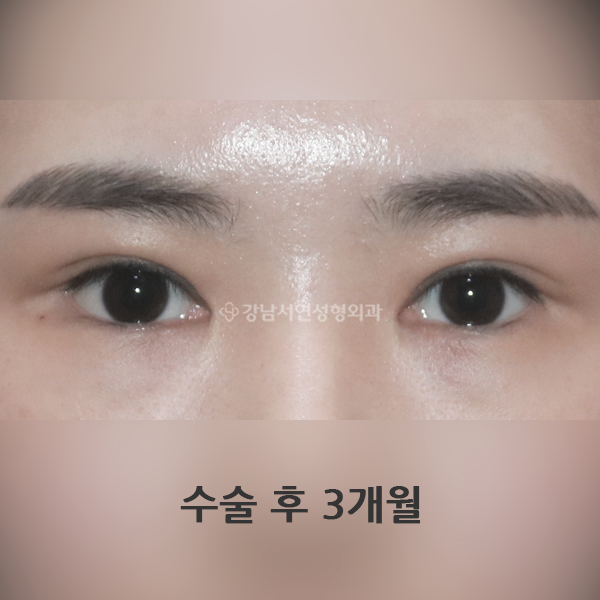 짝눈 교정 AFTER
