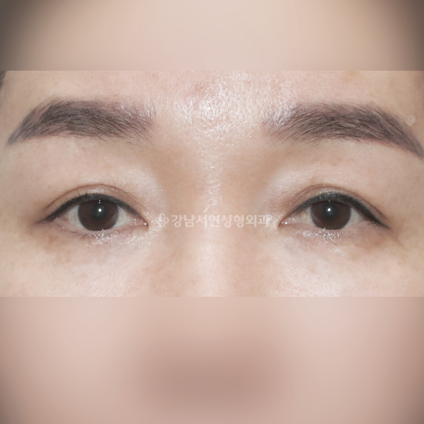 상안검 BEFORE