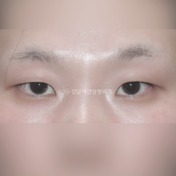 앞트임 + 절개쌍꺼풀(가성안검하수) BEFORE