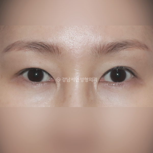 절개 쌍꺼풀 재수술 BEFORE