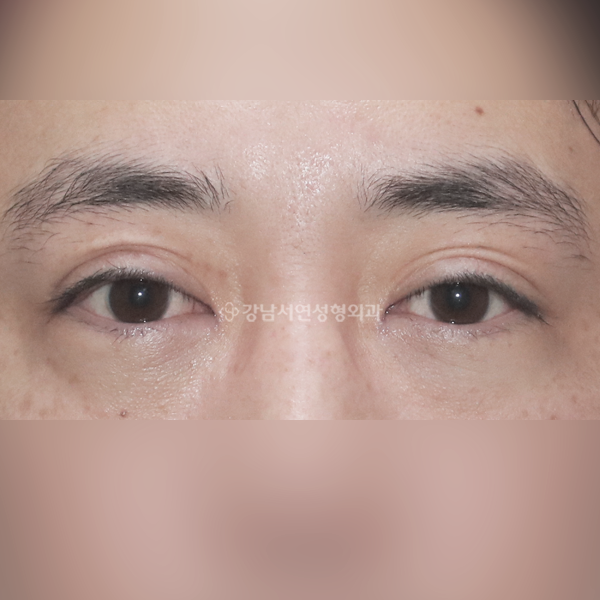 쌍꺼풀 재수술 겹주름 해결 BEFORE
