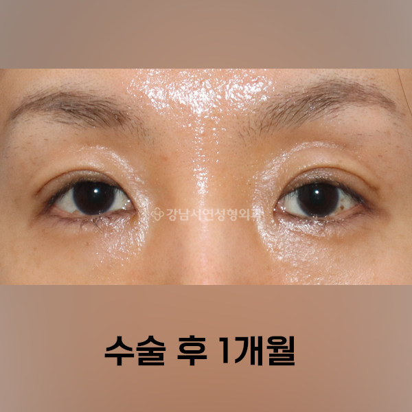 눈위 지방이식 + 쌍꺼풀 AFTER