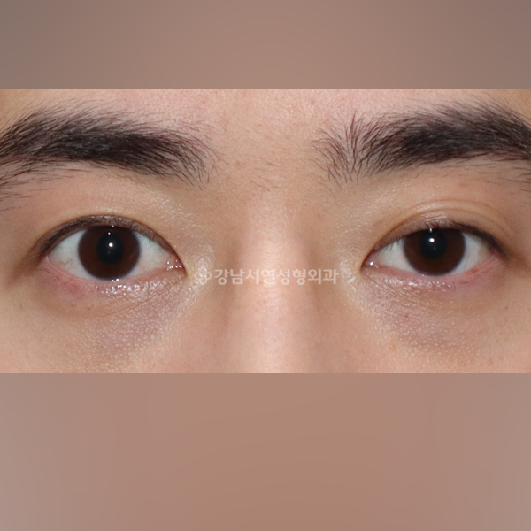 비대칭 눈매교정 BEFORE