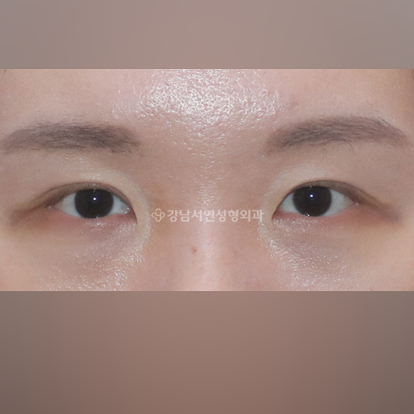 두줄따기 라인 낮추기 AFTER