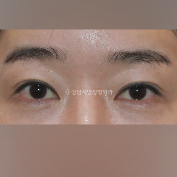 in에서 inout~semi-out 느낌 만들기 BEFORE