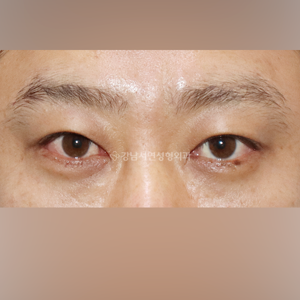 남자 쌍꺼풀 감추기 AFTER