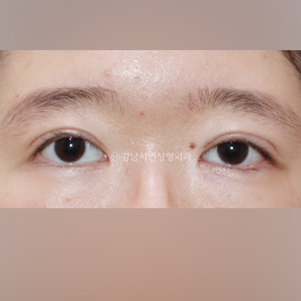 두줄따기 라인 낮추기 + 점막들림 개선 AFTER