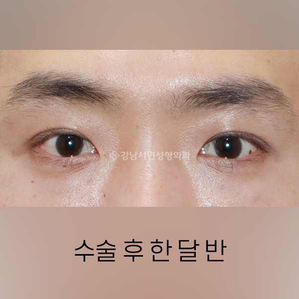 라인낮추기 + 눈매교정 AFTER