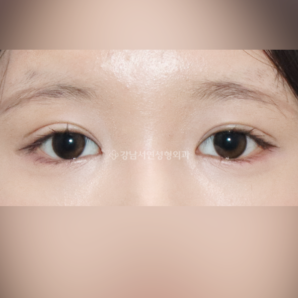 상안검 + 앞트임 AFTER