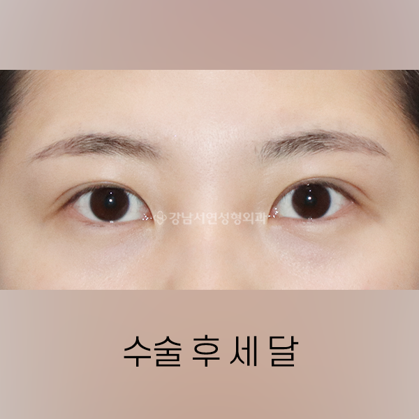 상안검 AFTER