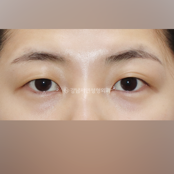 상안검 BEFORE