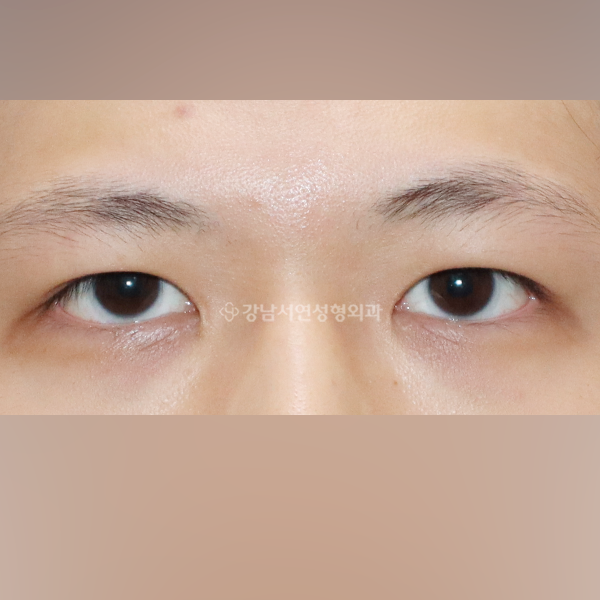 절개눈매교정 + 앞트임 AFTER