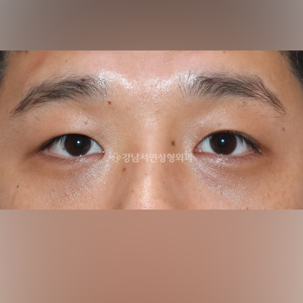 남자절개눈매교정 AFTER