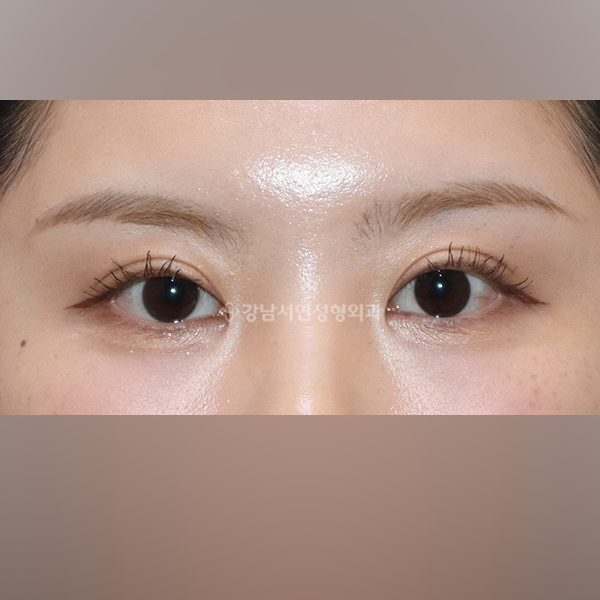 쌍꺼풀 재수술 AFTER