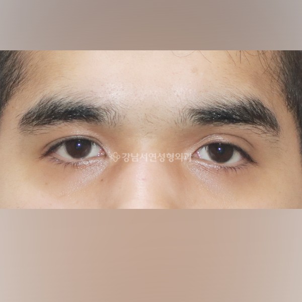 쌍꺼풀 라인 감추기 BEFORE