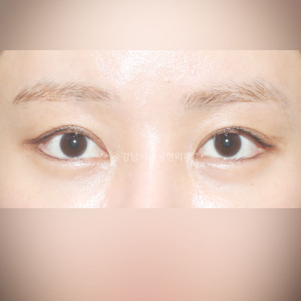 조기교정 AFTER