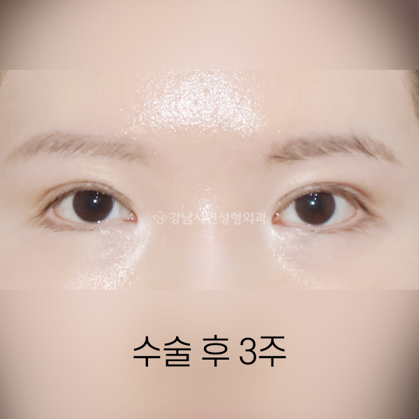 퇴축수술 AFTER