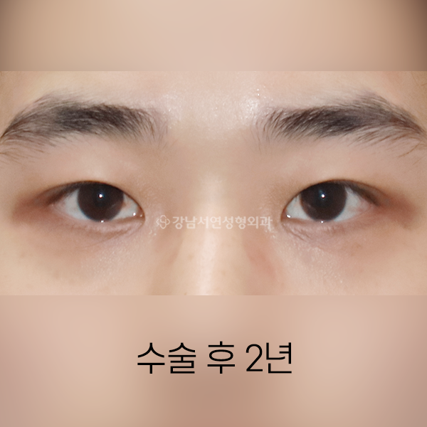 남자 눈성형 AFTER