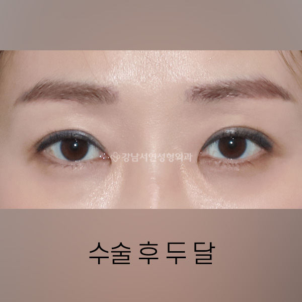 눈꺼짐 개선 및 쌍꺼풀 재수술 AFTER