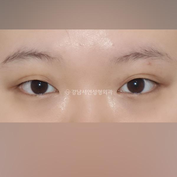 세미아웃라인 절개쌍꺼풀 BEFORE