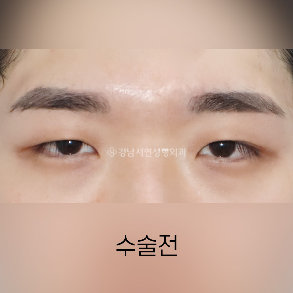 절개쌍꺼풀 BEFORE