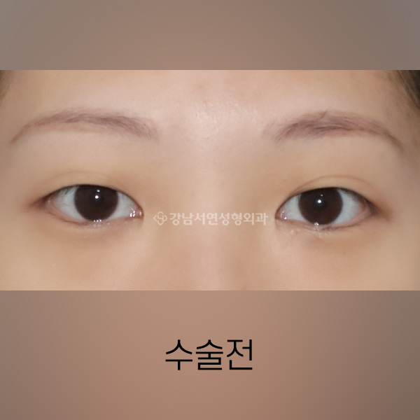 매몰 쌍꺼풀 재수술 BEFORE