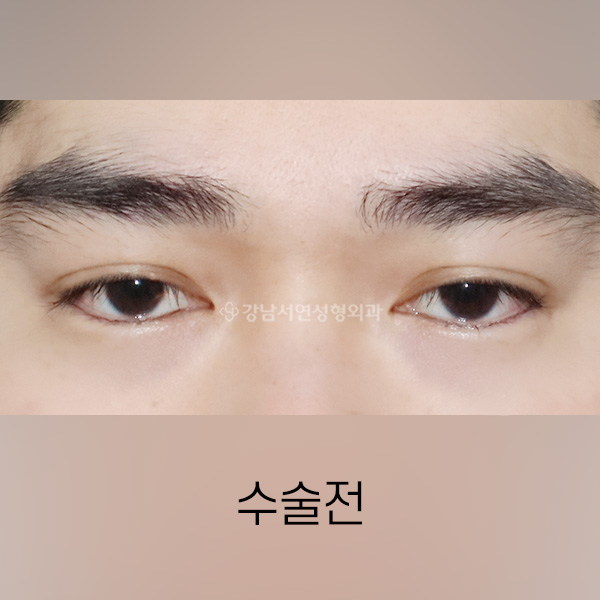 남자 쌍꺼풀 낮추기 BEFORE