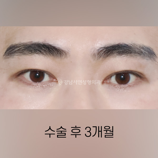 남자 쌍꺼풀 낮추기 AFTER