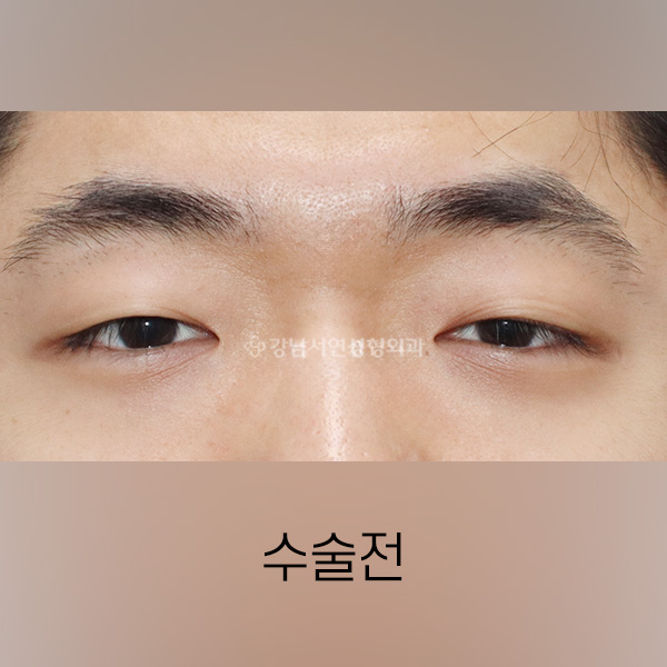 절개쌍꺼풀 + 앞트임 BEFORE