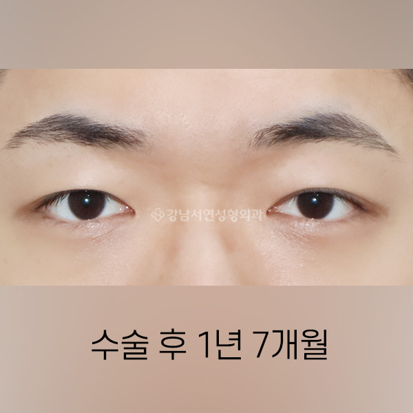 절개쌍꺼풀 + 앞트임 AFTER