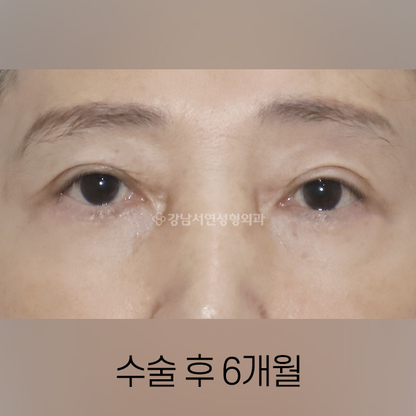 상안검 + 하안검 AFTER