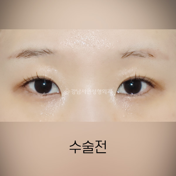 뒤밑트임 BEFORE