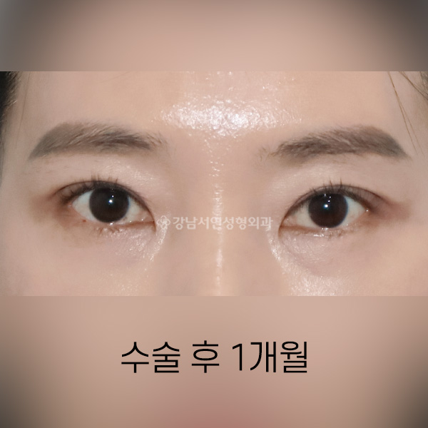 절개쌍꺼풀 AFTER