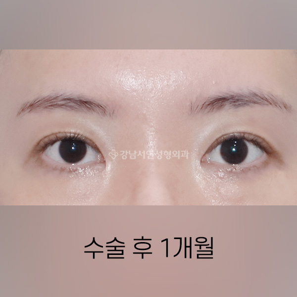 두줄따기 AFTER